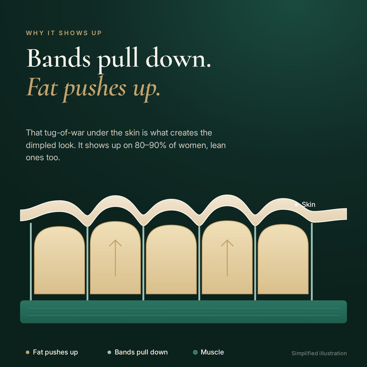 Illustration of why cellulite shows up: bands pull the skin down while fat pushes up